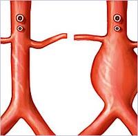 diagnosticare l’aneurisma dissecante dell’aorta facendo pronunciare la lettera “a” al paziente