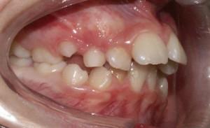 I denti  “a coniglietto” , ce ne parla l’ortodontista