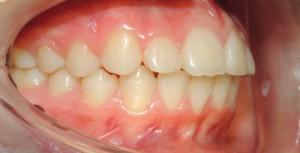 I denti  “a coniglietto” , ce ne parla l’ortodontista