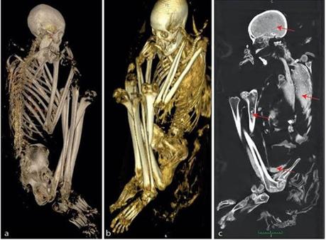 La mummia Tuli, rarissimo esempio di mummia del sud Africa