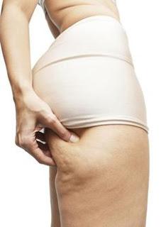 Perché abbiamo la cellulite? Perché abbiamo la cellulite?