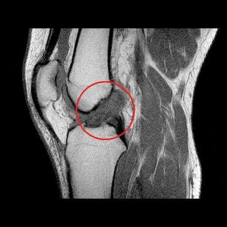 Che mazzata! Risonanza Magnetica Legamento Crociato Anteriore LCA Infortunio Ginocchio Edema spongiosa Diario 