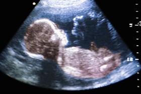 Alabama: aborto vietato dopo le 20 settimane per dolore fetale