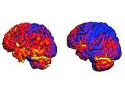 Dall’Australia una ricerca per la diagnosi precoce dell’Alzheimer