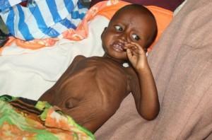 Somalia continua la fame ospedali sovraffollati