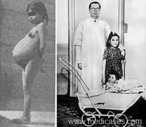 partorire a 5 anni: è accaduto a Lina Medina nel 1939