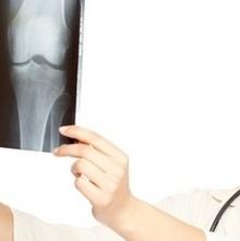 Osteoporosi: ne soffre il 17% delle italiane osteoporosi