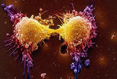Tumori scoperta la possibilità di fermare il Cancro - Ma moriranno ancora in tanti -