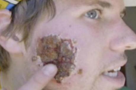 parassita mangia faccia a ragazzo a londra LONDRA: Un parassita divora la faccia ad un ragazzo| FOTO