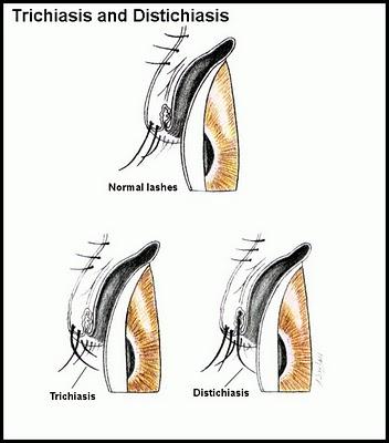 DISTICHIASI -TRICHIASI NEL CANE
