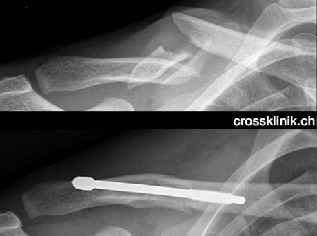 Frattura clavicola Fabian Cancellara: la radiografia