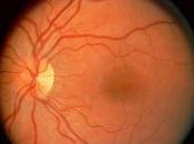 Distacco della retina: alcuni antibiotici aumentano rischio