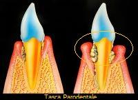 Tasca parodentale – Parodontite
