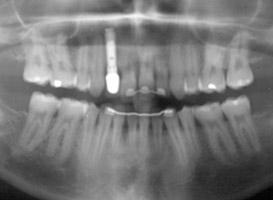 Analisi radiologiche ai denti: un pericolo per la salute?