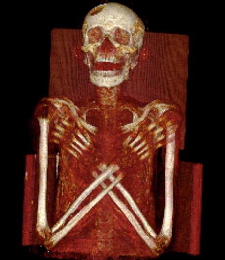 Le prove del cancro sulla mummia di un giovane Egizio