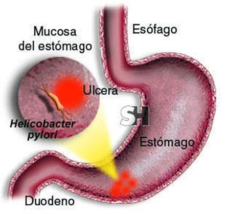 Ulcera gastrica dieta e cure naturali