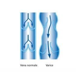 I protocolli terapeutici: prevenire e curare le varici