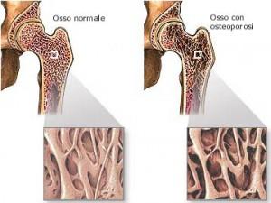 Allarme osteoporosi: le donne che ne soffrono non sono seguite da un medico