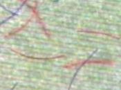 Morbo Morgellons: scie chimiche, complotto semplicemente patologia