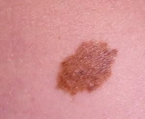 Molecola anti melanoma, la scoperta dei ricercatori italiani