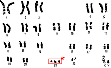 Esercizi di genetica: sindrome di Down