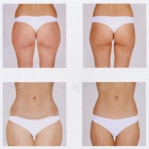 Cavitazione estetica, cellulite addio ma con prudenza!