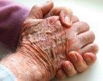 Riabilitazione dell’ictus pazienti anziani