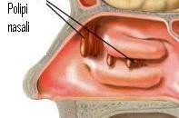 Poliposi nasale, sintomi e cura