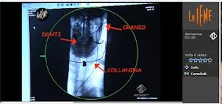 Sclerosi multipla: al via la sperimentazione clinica con il metodo Zamboni sulla CCSVI