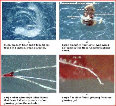 Il Morgellons: una nanotecnopatologia