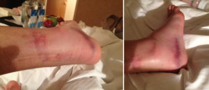 Le foto del piede di Casey Stoner dopo la gara di Indianapolis