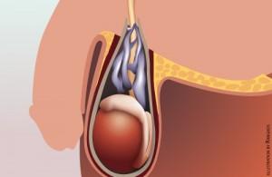 Varicocele, cos’è e come curarlo