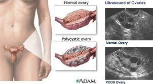 PCOS, La sindrome dell’ovaio policistico