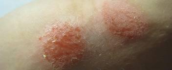Dermatite in aumento a causa dell’eccessivo uso di cosmetici.