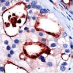 immagine molecolare cancro alla prostata 