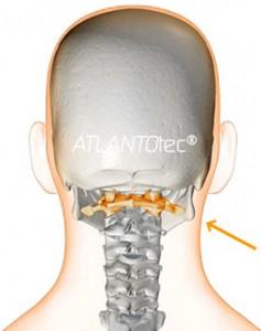 riequilibrio prima vertebra atlante con atlantotec