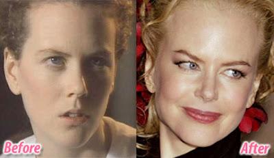 Le star prima e dopo il chirurgo: Nicole Kidman