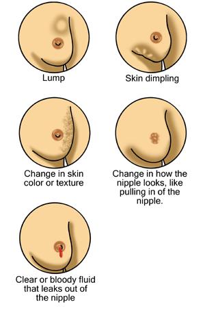 File:En Breast cancer illustrations.gif