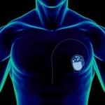 Cuore, negli Usa il primo pacemaker senza batterie