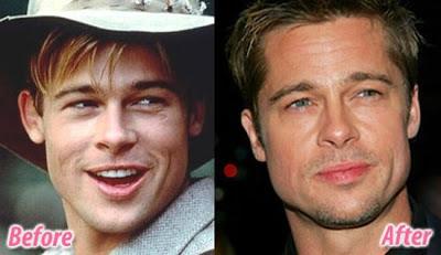 Le star prima e dopo il chirurgo: Brad Pitt