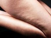 Cellulite: Rimedi Precauzioni Scacciare Sintomi della Cellulite