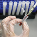 PSA nuovo sensore HIV antigene prostatico specifico 