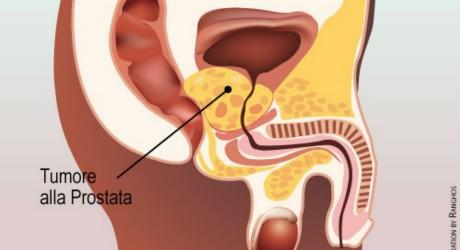 tumore-alla-prostata