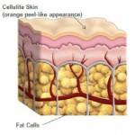 riduzione cellulite pelle a buccia d’arancia cambiamenti ormonali 