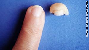 Cinque settimane per rigenerare la punta del dito