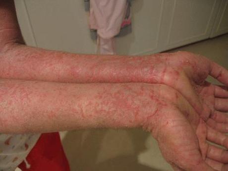 Eczema disidrosico: quando la pelle si riempie di bolle