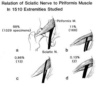 La sindrome del piriforme