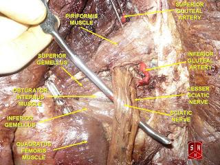 La sindrome del piriforme