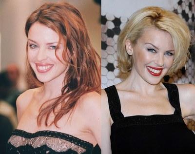 Le star prima e dopo il chirurgo: Kylie Minogue