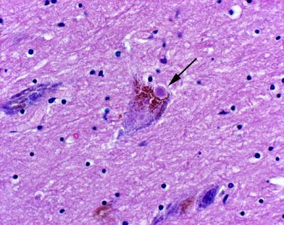 Il deficit di zolfo, il morbo di Alzheimer ed il morbo di Parkinson